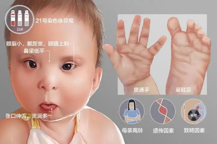 21号染色体异常